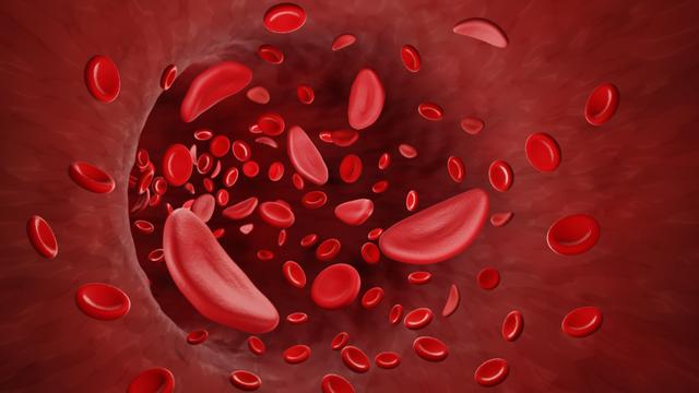 Illustration of sickle-shaped red blood cells associated with sickle cell disease and Oxbryta safety concerns
