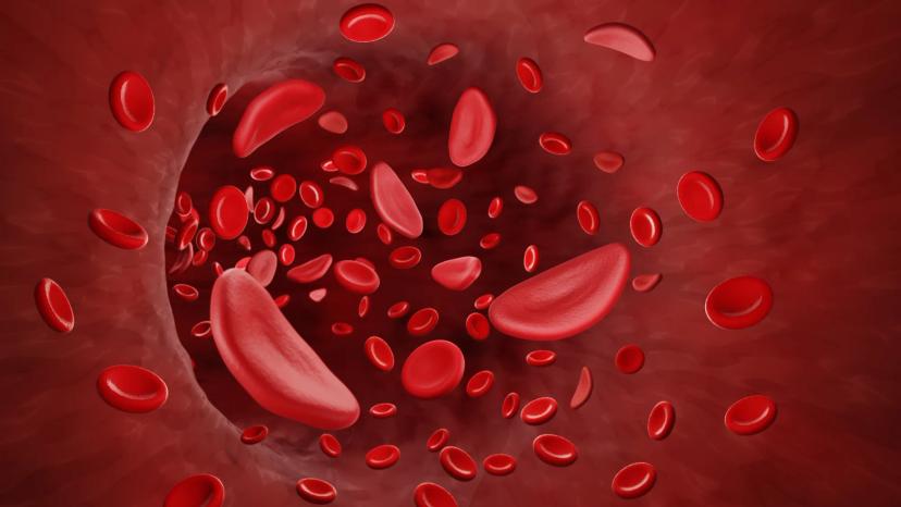 Illustration of sickle-shaped red blood cells associated with sickle cell disease and Oxbryta safety concerns